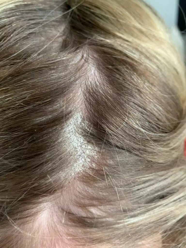 Trycholog Bydgoszcz – Milena Kwaśniewska, specjalizuję się w diagnostyce i leczeniu problemów skóry głowy oraz włosów, oferując profesjonalne konsultacje i indywidualnie dobrane terapie. Nowa 15, 85-119 Bydgoszcz https://milena-trycholog.pl